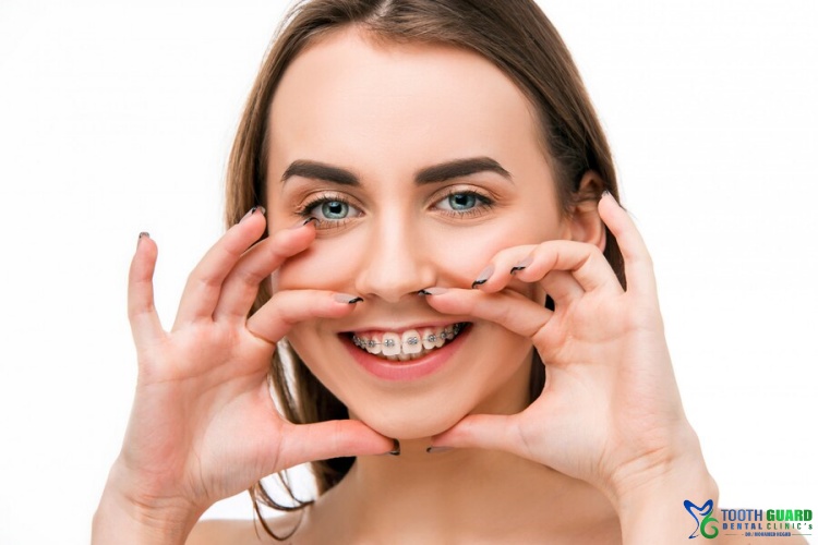 سعر تقويم الاسنان الفك العلوي فقط